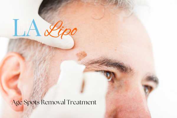 What Are the Most Effective Treatments for Age Spots Park Royal?