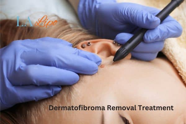 Dermatofibroma Removal Treatment Park Royal