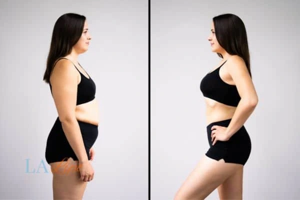 image of woman before and after results of LA-EMS Body Sculpting Park Royal to help treat Diastasis recti