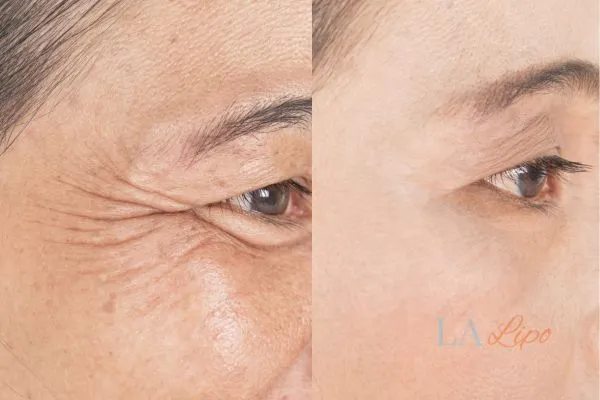 Before and after results of woman - HI-fu wrinkles reduction treatment Park Royal