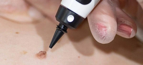 skin tag removal using cryopen Park Royal