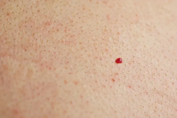 close up of a cherry angioma Park Royal
