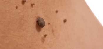 image of a skin tag Park Royal