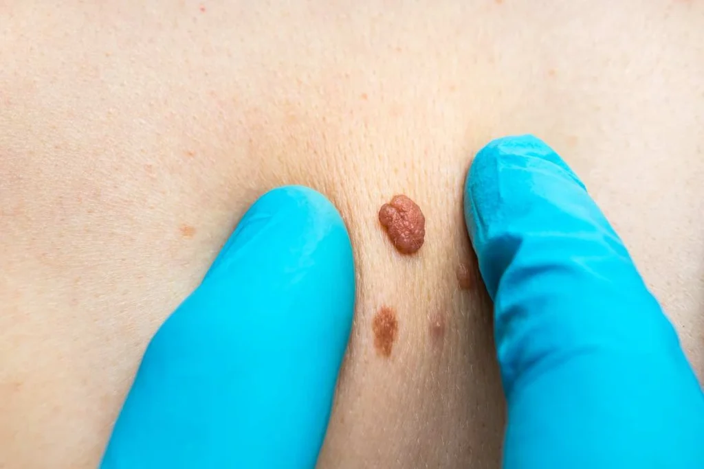 Consultant examining a skin tag Park Royal