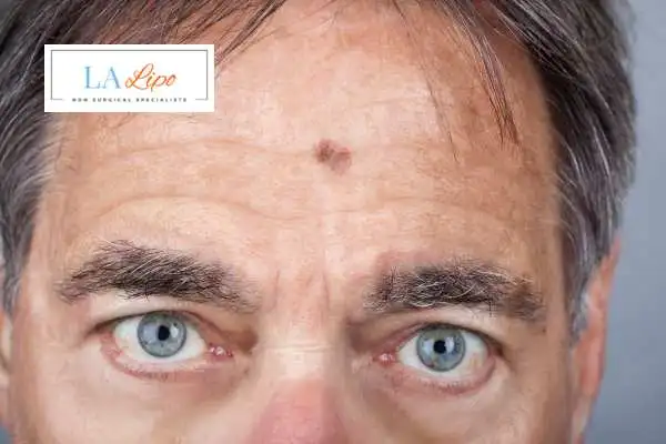 Solar Lentigo Removal Park Royal image of man with mark on his forehead