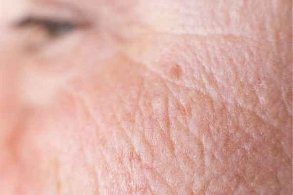 close up picture of a woman's face showing an age spot Park Royal