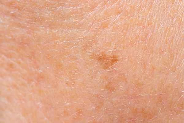 close up picture of age spots Park Royal