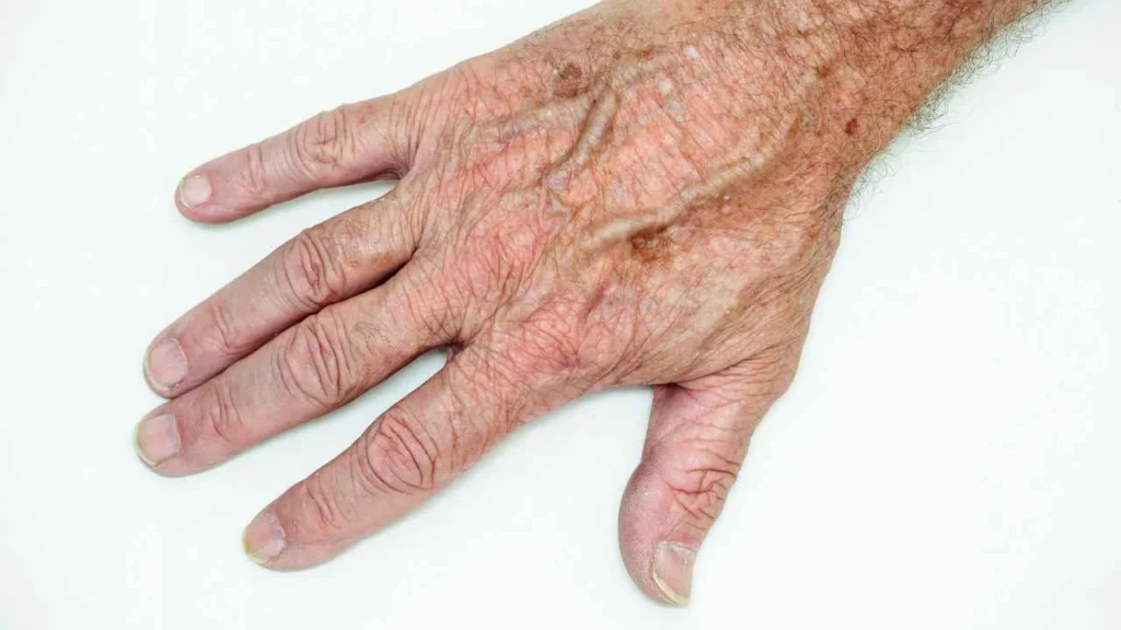Male hand showing age spot Park Royal