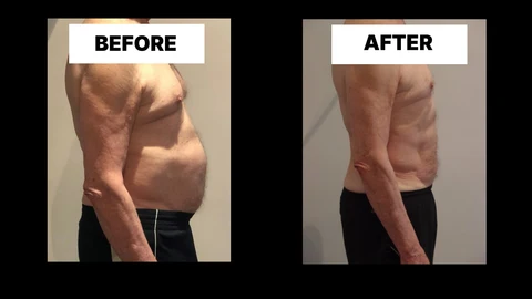 What Symptoms Can Diastasis Recti Cause in Men? Weak Core, Back Pain and Poor Posture Park Royal